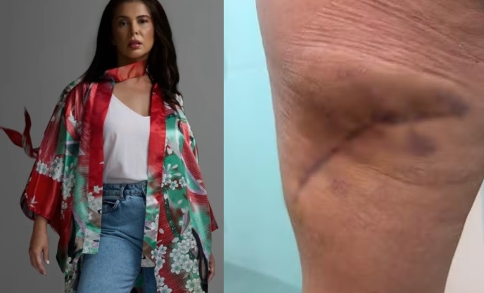 Modelo sofre necrose na pele por conta de procedimento estético e clínica é interditada em Jaraguá do Sul
